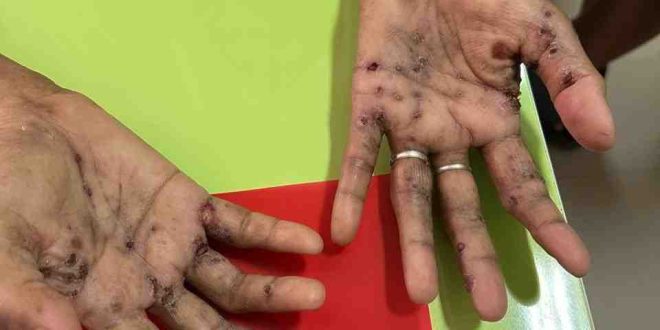 Tangan seorang perempuan di Palembang yang diduga suspek cacar monyet. Foto: Dok Puskesmas.