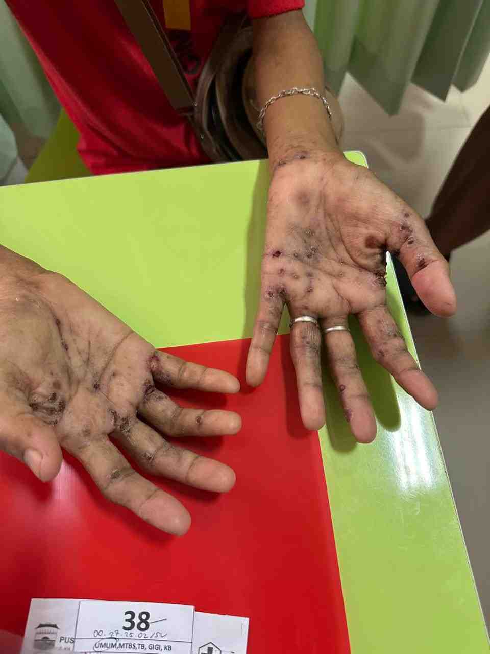 Tangan seorang perempuan di Palembang yang diduga suspek cacar monyet. Foto: Dok Puskesmas.