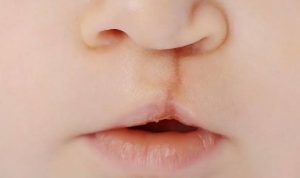 Ilustrasi bibir sumbing. Foto: IST